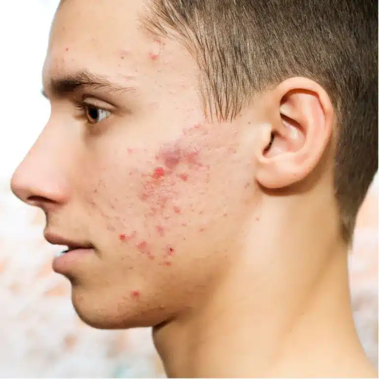 Acné hormonal