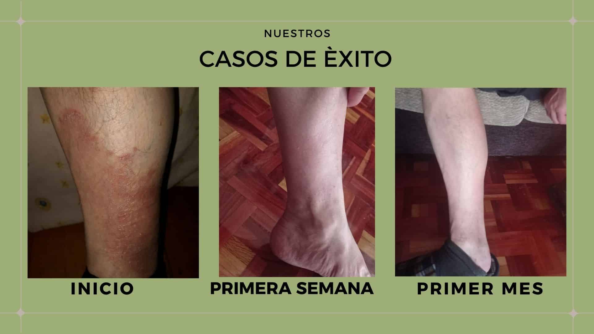Dermatitis por estres fotos